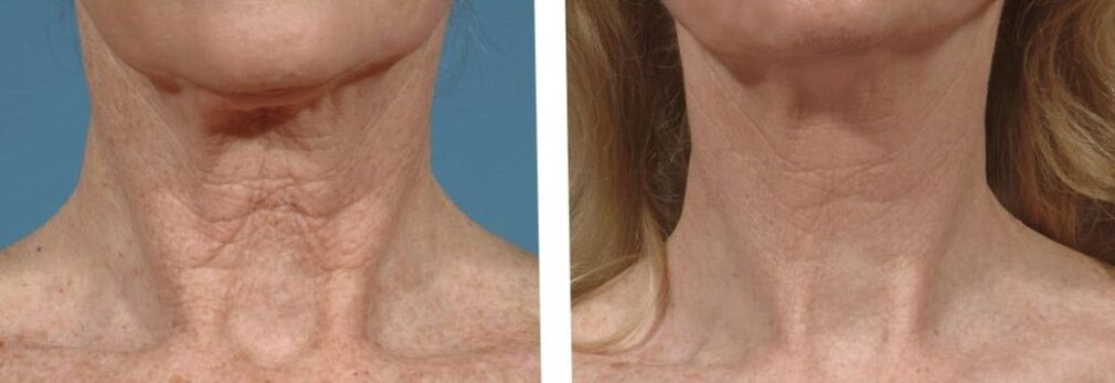 olu akpụkpọ tupu na mgbe fractional rejuvenation