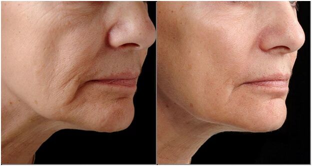 Tupu mgbe na mgbe laser rejuvenation