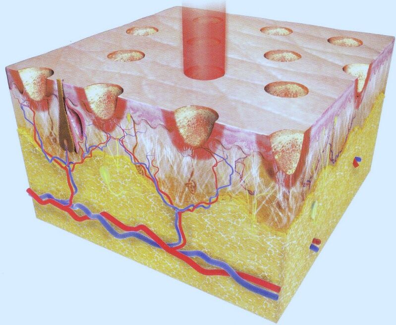 Laser na-ere ọkụ akụkụ nke mkpụrụ ndụ akpụkpọ ahụ, na-amanye gburugburu ebe obibi ha ka ha nwekwuo mmụba. 